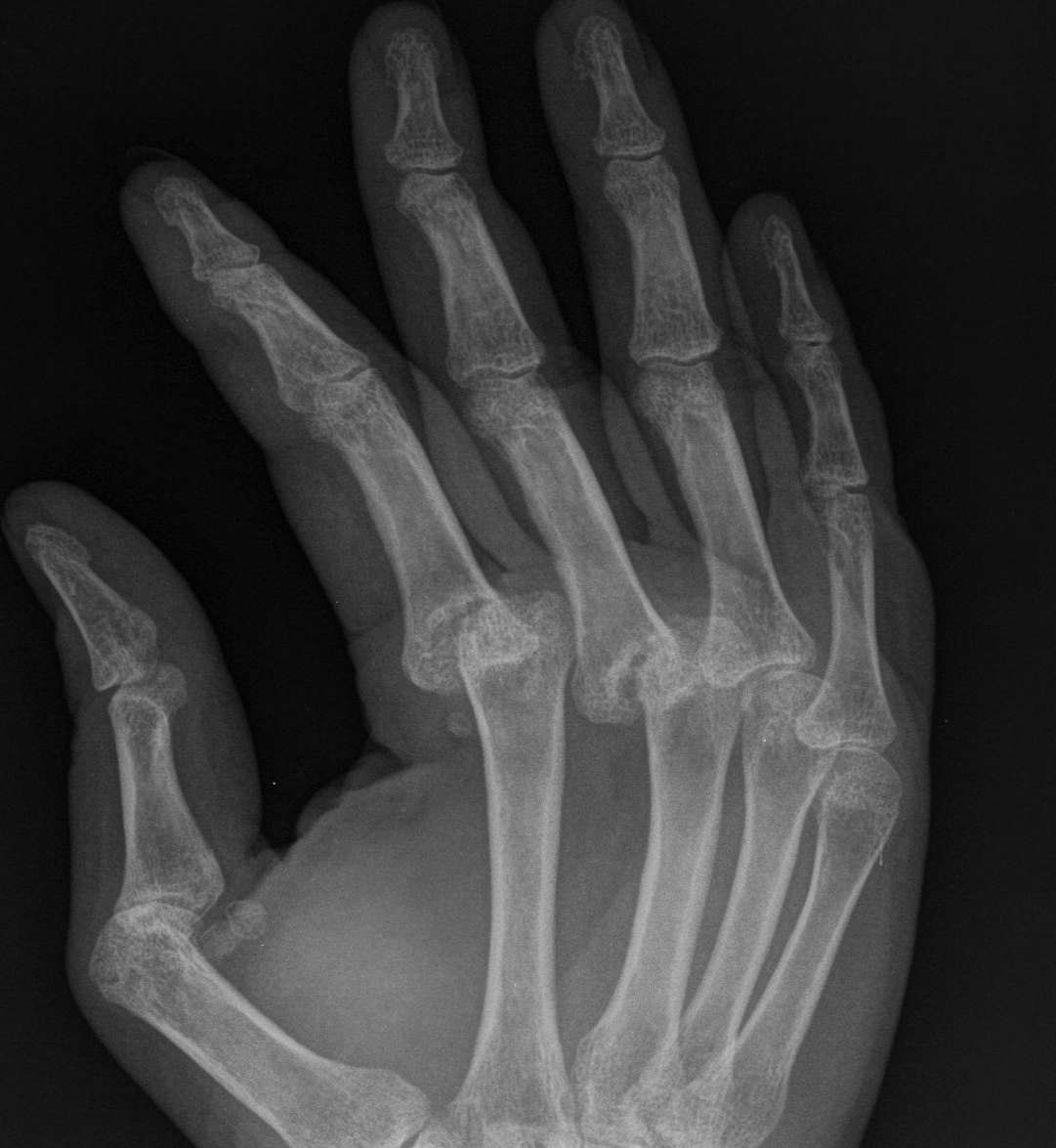 Rheumatoid Dislocated MCPJ